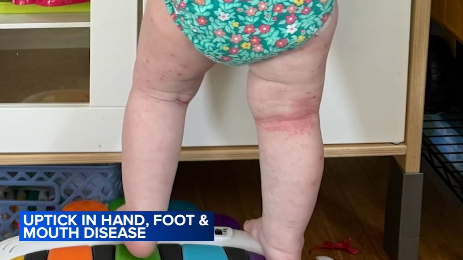Hand, Foot and Mouth Disease (HFMD) cases grow as viral spread picks up across Philadelphia region
