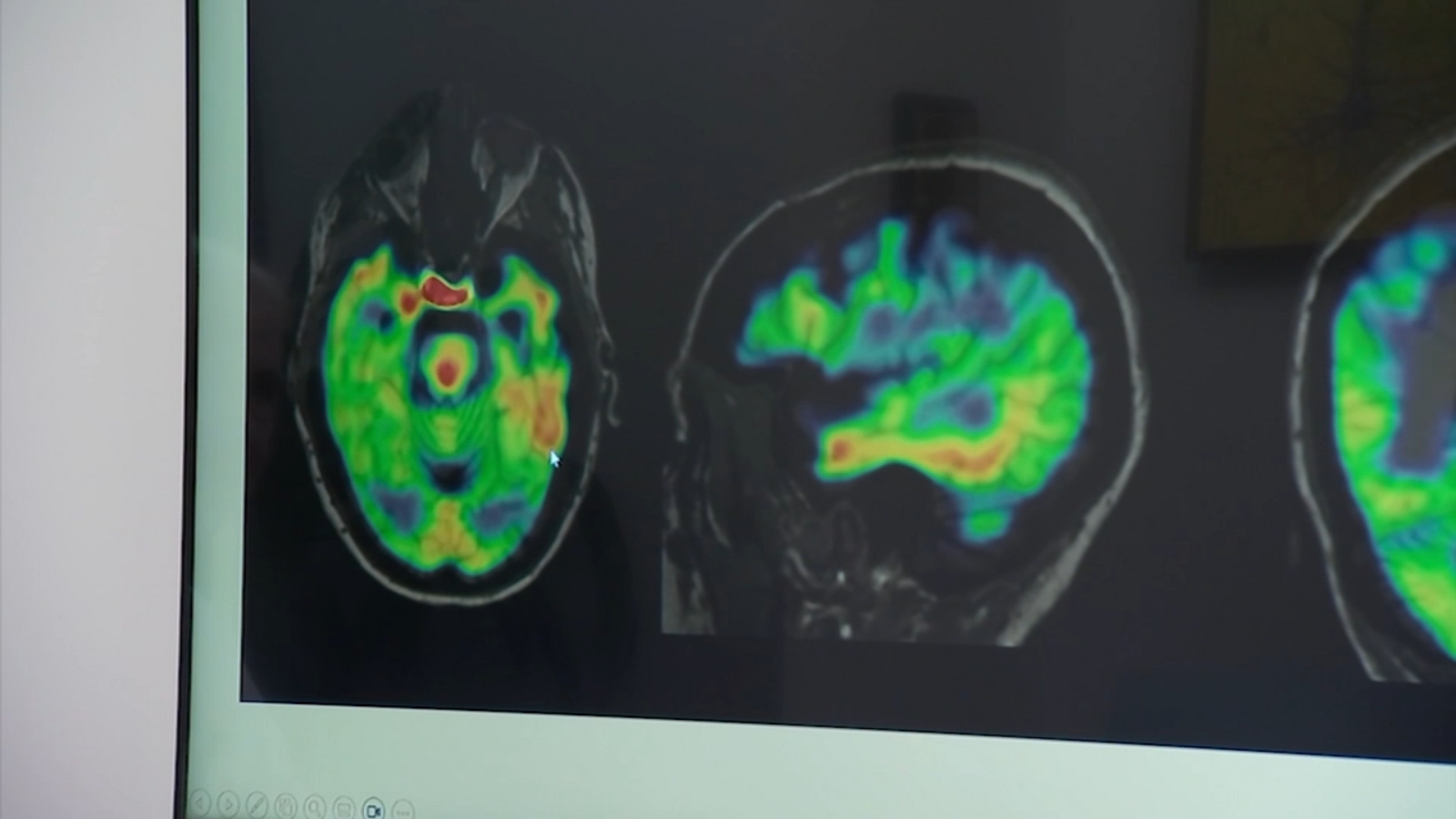 Houston healthcare employees work to treat patients and find cure for frontotemporal dementia