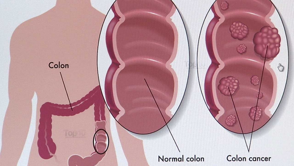 Colon cancer cases rising among millennials, study says