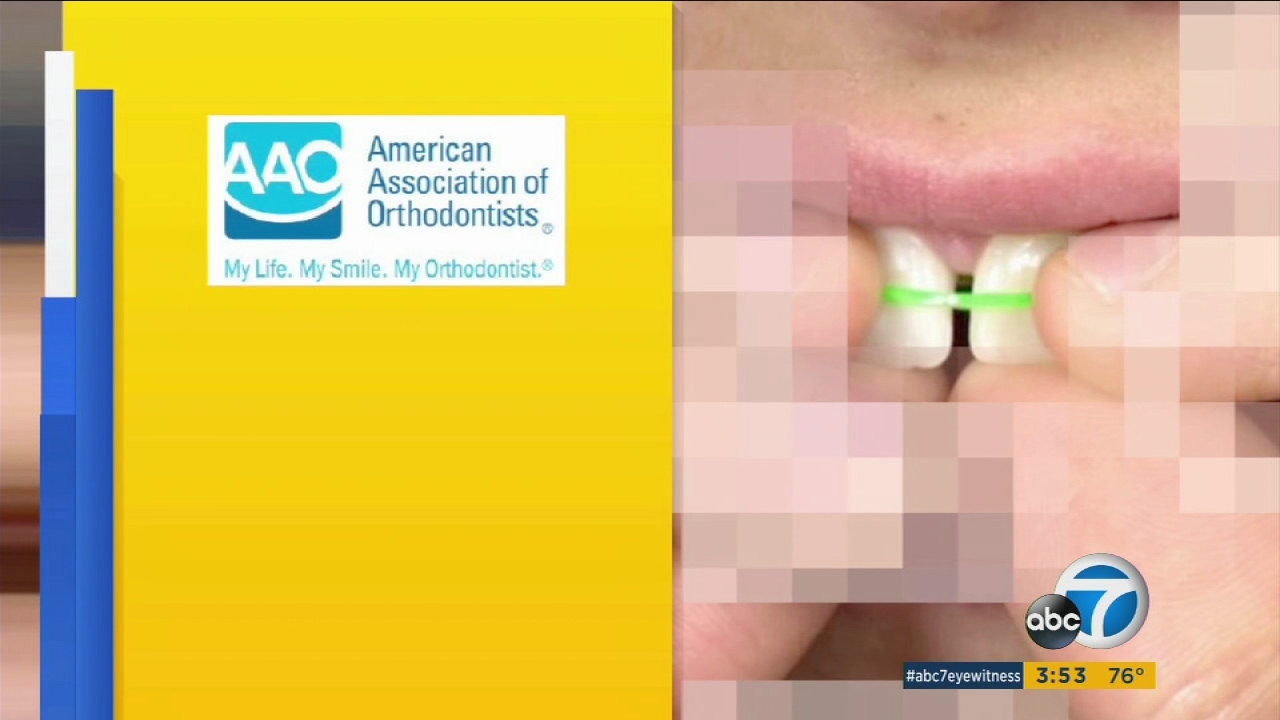 'DIY braces' trend permanently damaging kids' teeth