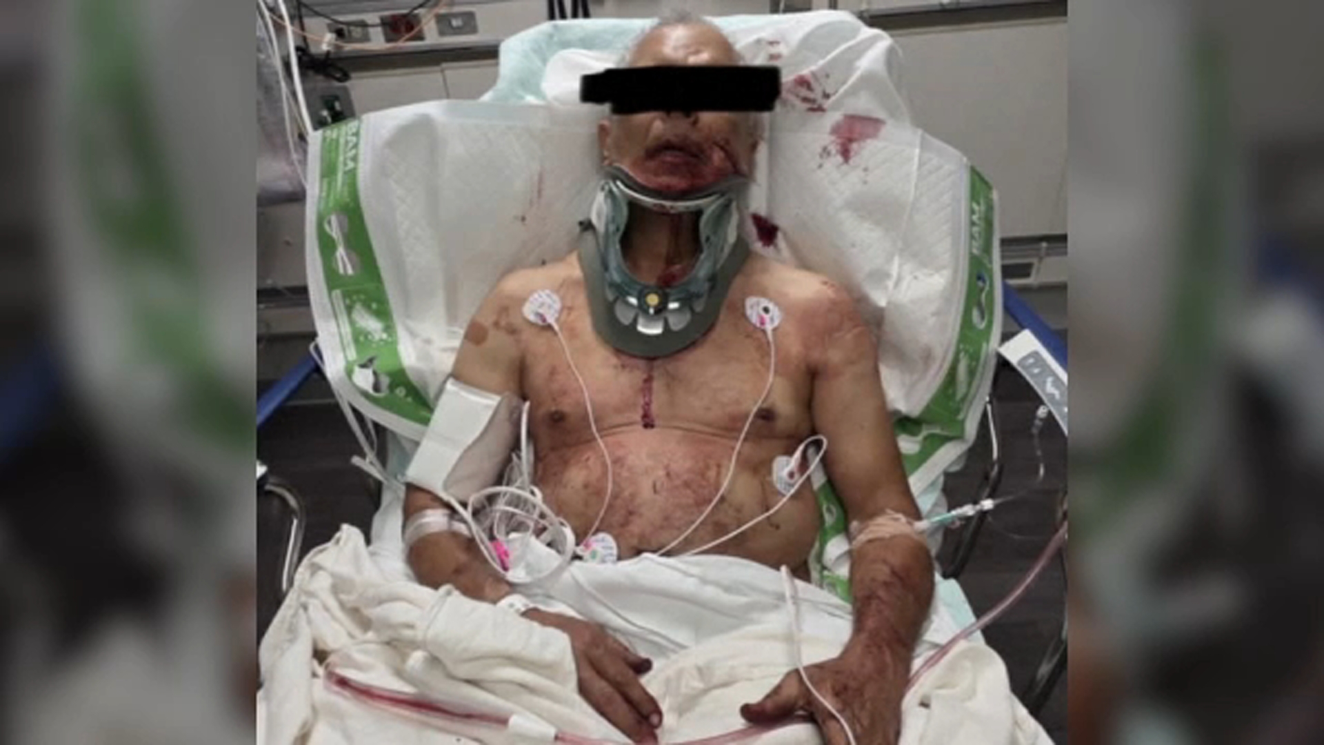 Indianapolis ABC affiliate WRTV obtained this photo, with the black bar in place, showing who his family says is the alleged victim in the hospital.