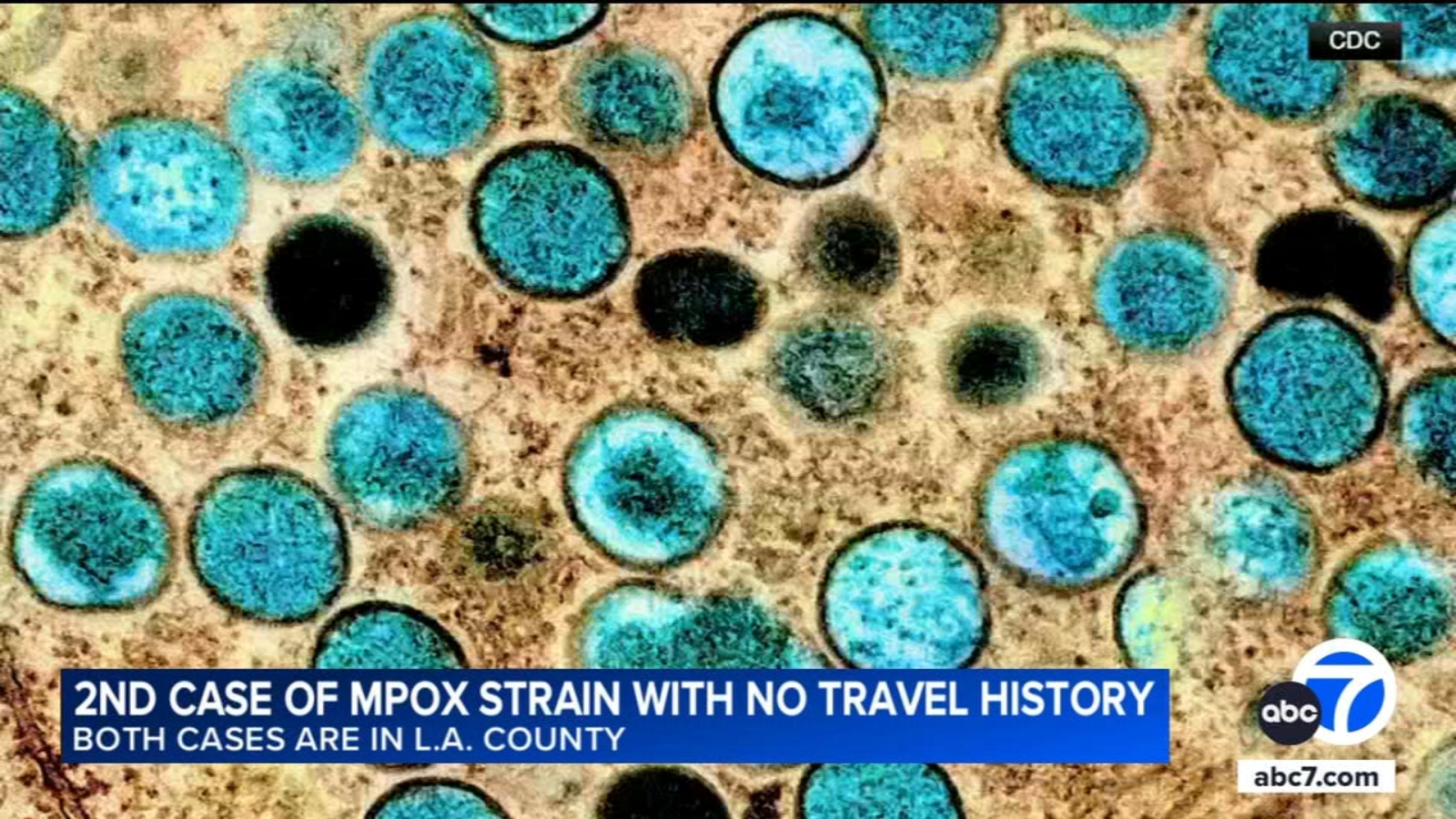 2nd case of severe mpox strain confirmed in LA County patient with no ...