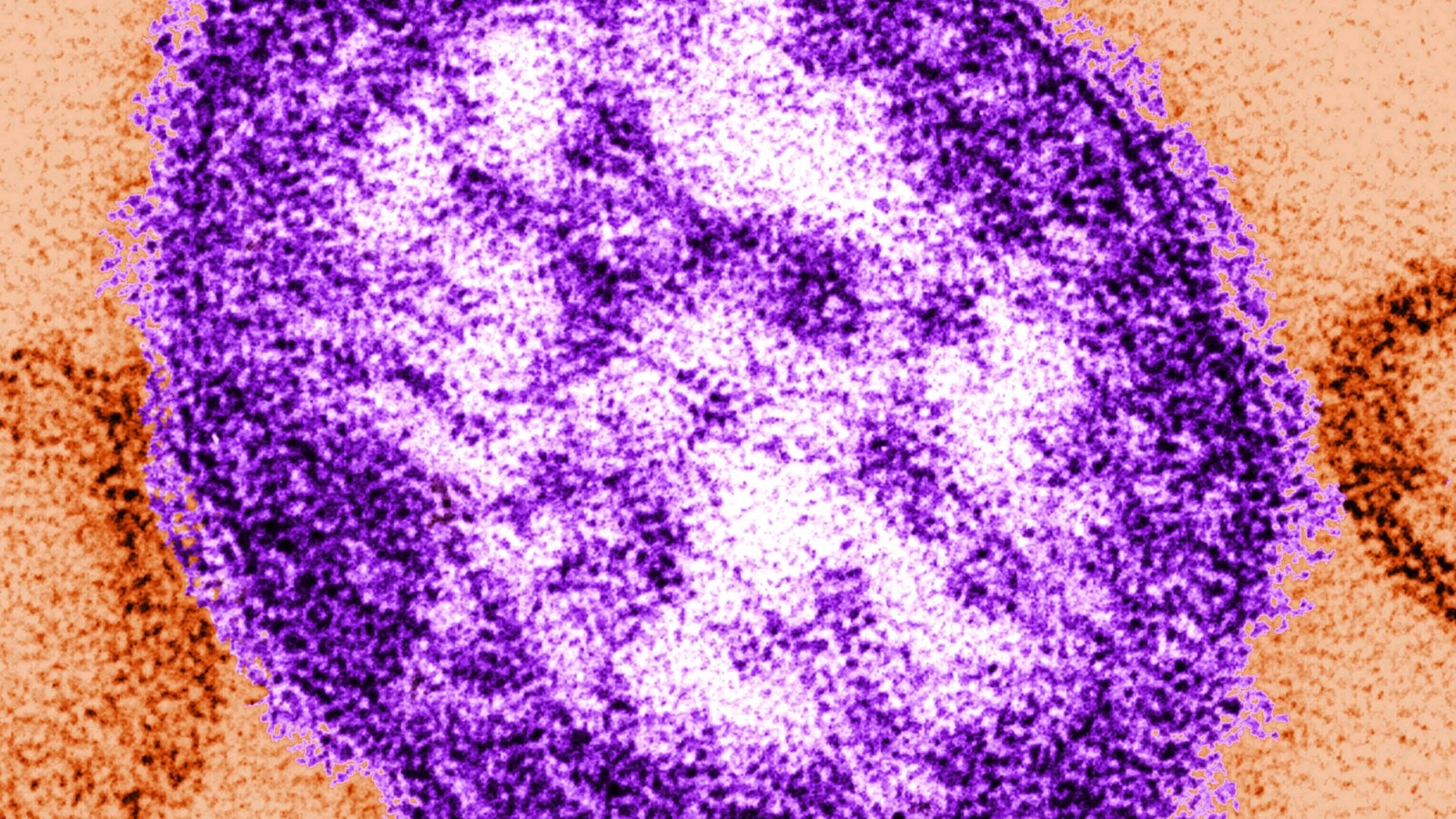New Jersey officials warn of potential measles exposure at Newark Airport
