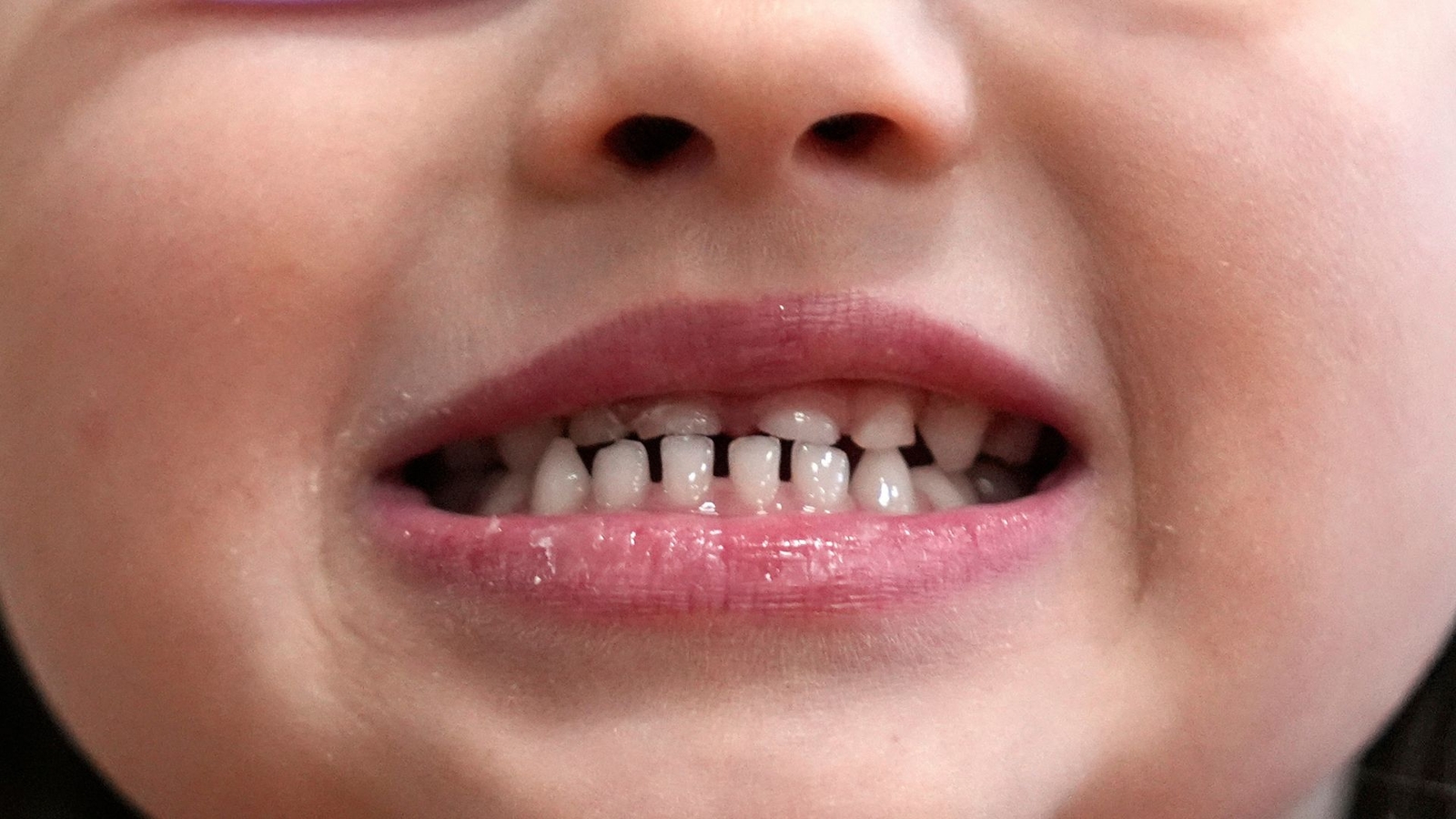 FDA restricts use of kids' fluoride supplements citing emerging health risks