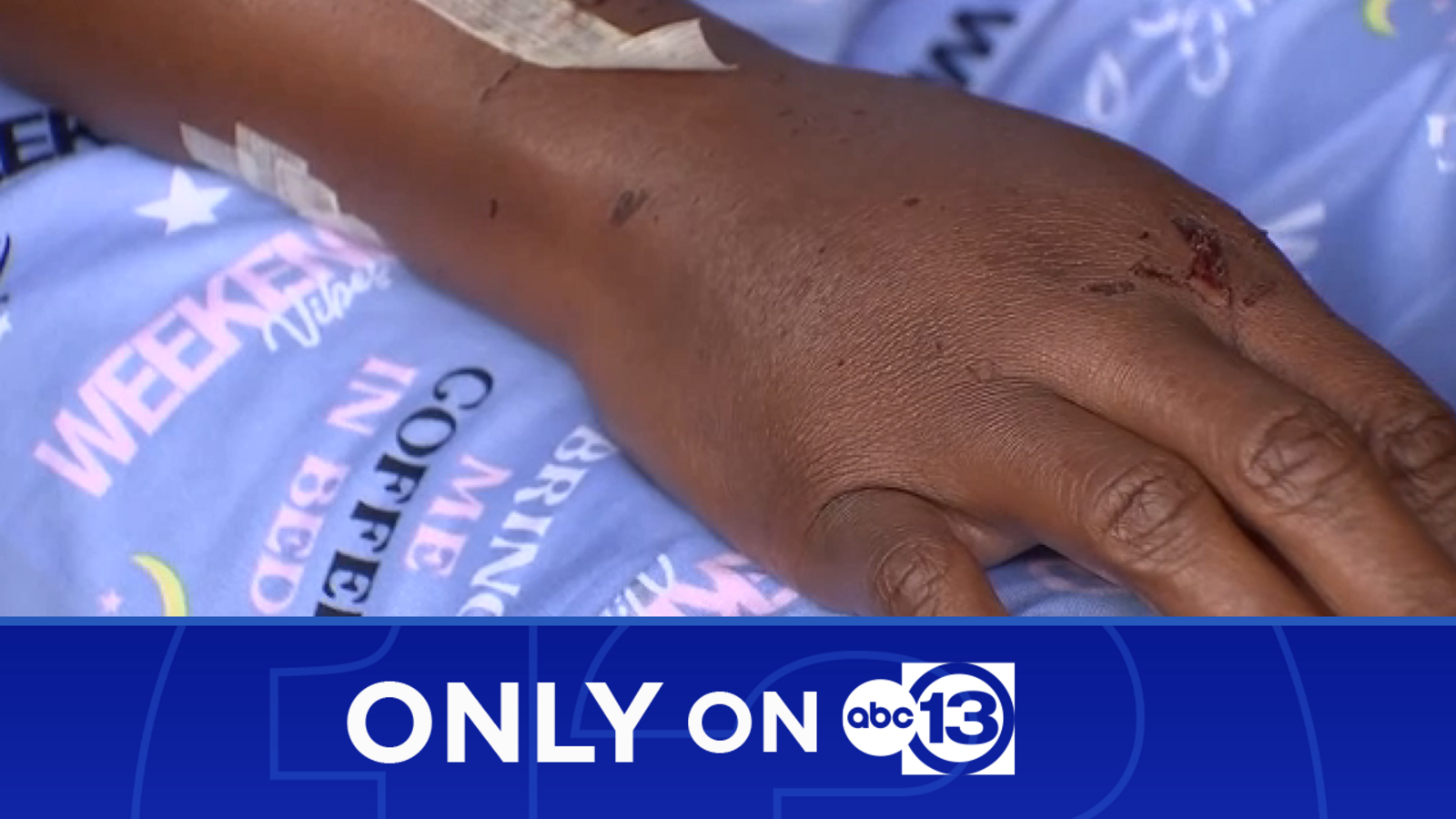 Only on 13: Harris County woman attacked by dog speaks with ABC13 about ...