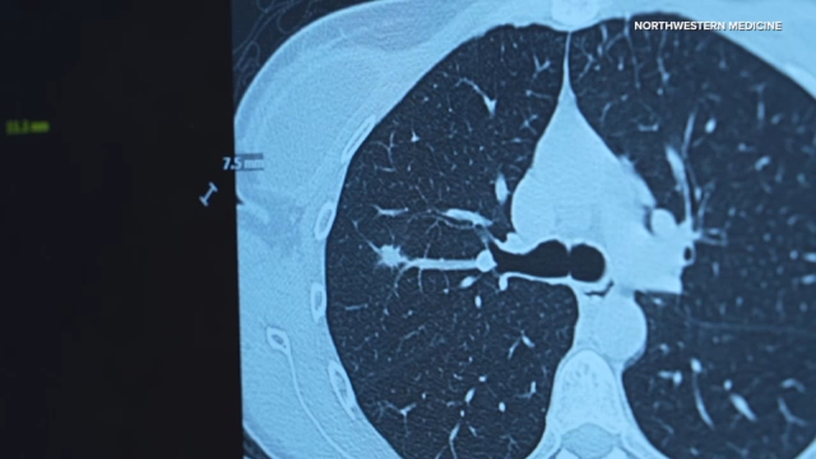 Northwestern Medicine Chicago study recommends expanded lung cancer screenings for younger ages, women - ABC7 Chicago