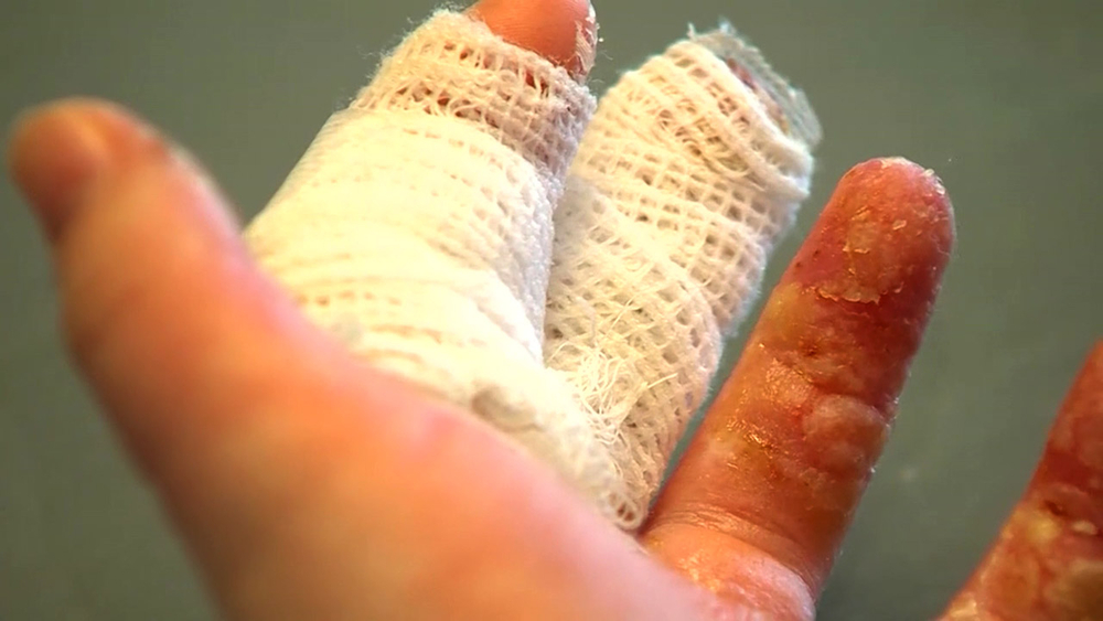 Girl ends up with 3rd-degree burns from do-it-yourself homemade slime