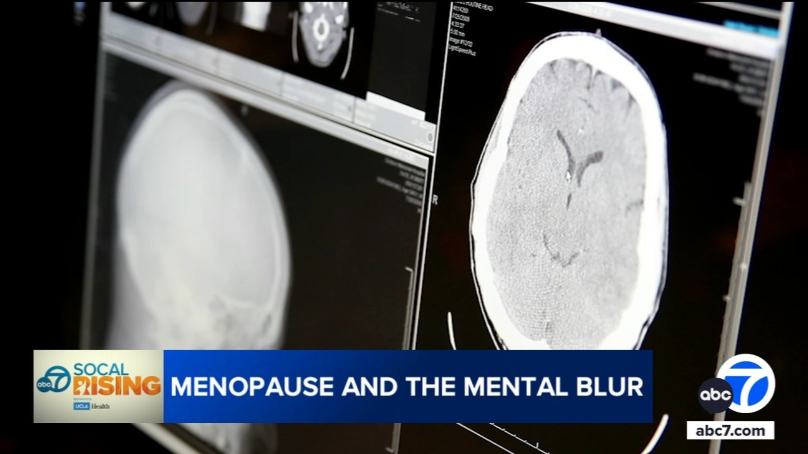 New UCLA study finds hormone therapy could protect women’s brains as they age, during menopause