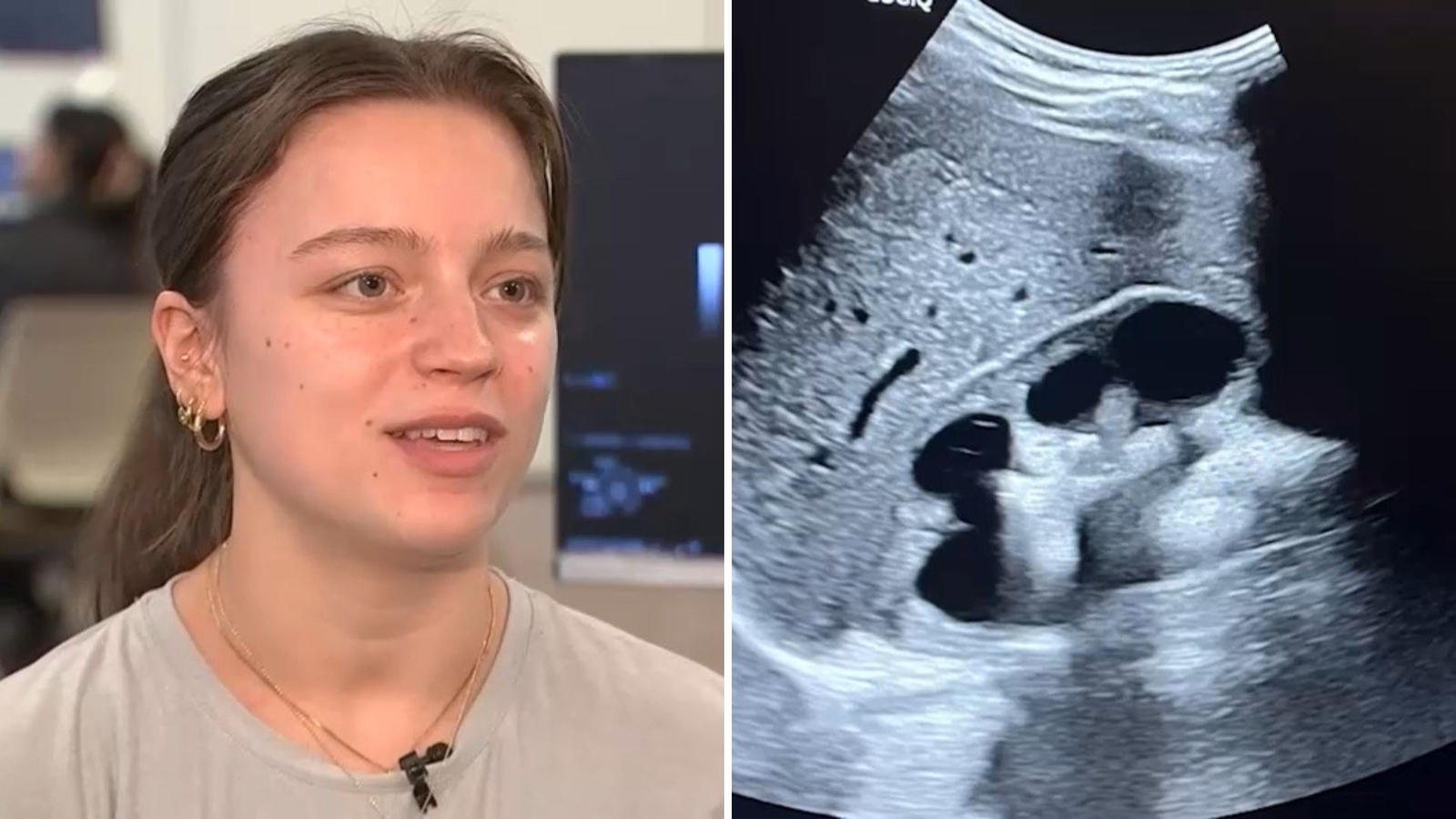 Medical lesson turns into life-saving discovery of mass on student's kidney at Hofstra University