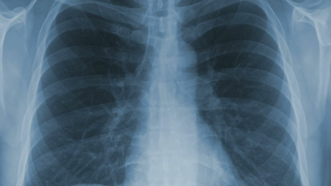 Supporting patients and families through an incurable lung disease