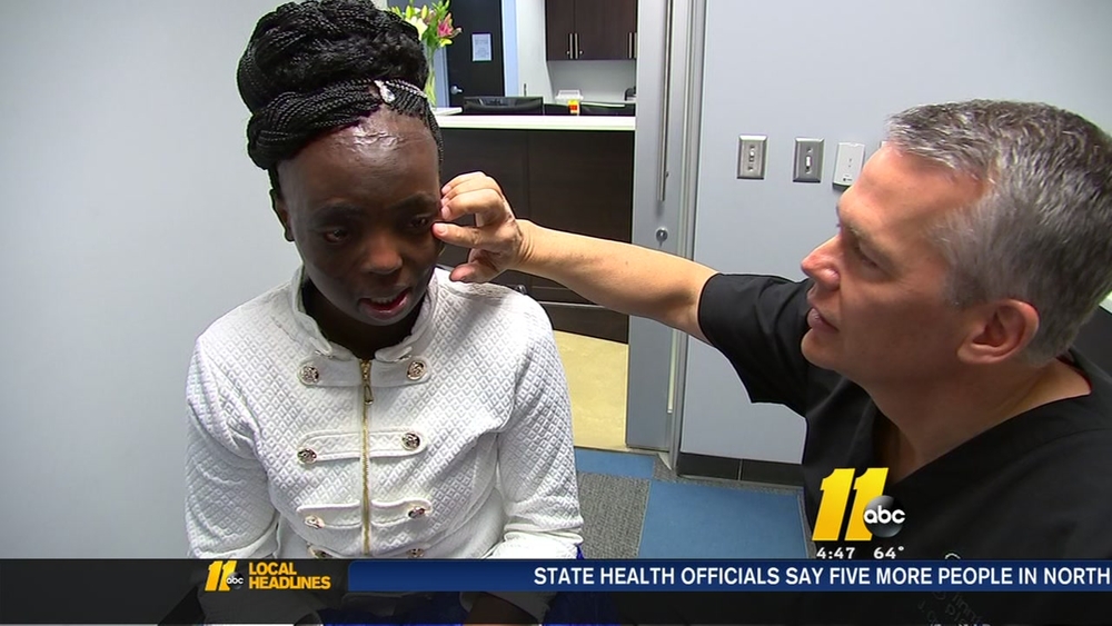 Burned woman gets life-changing surgery for free
