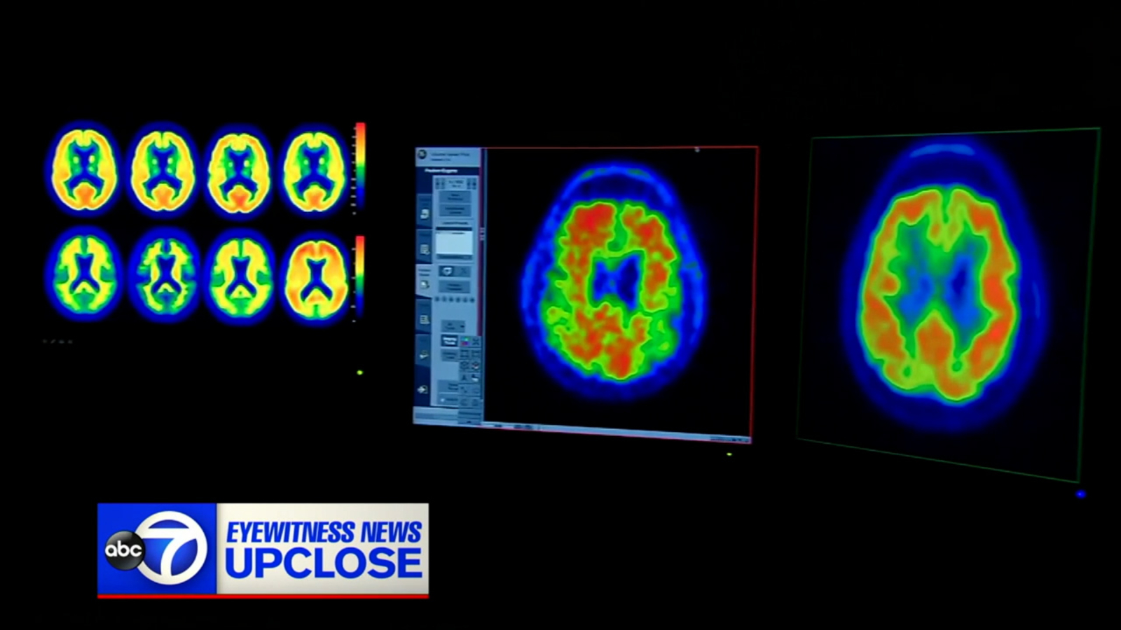 Up Close: Understanding Alzheimer's disease after NJ Sen. Andy Kim opens up about father's diagnosis