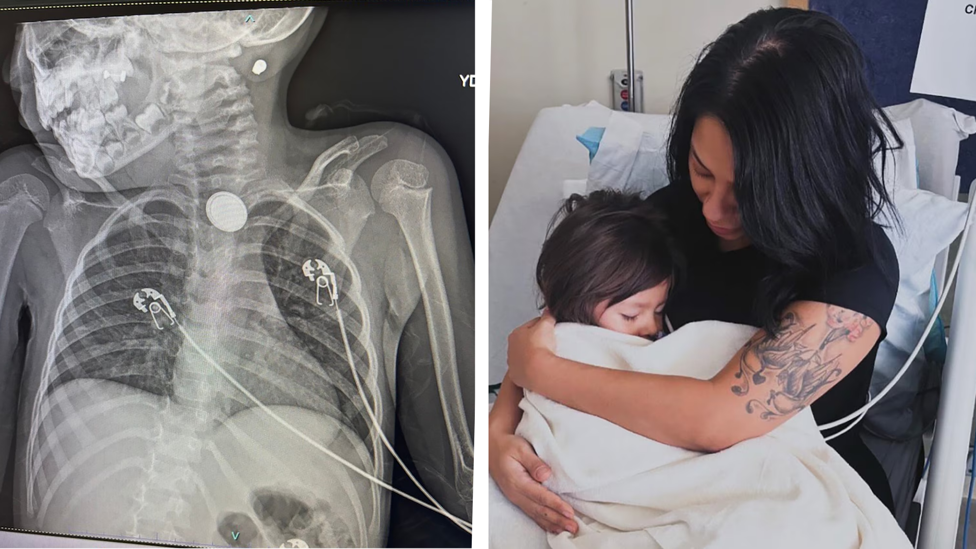 This split image shows an X-ray photo shows a small battery inside 4-year-old Elana's body, left, and Elana with her mother, Jess Sandoval, at Children's Hospital in Aurora.
