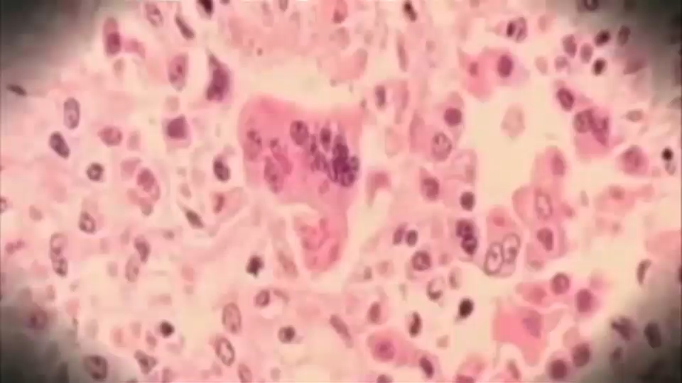 Possible measles exposure at Newark Airport on December 12