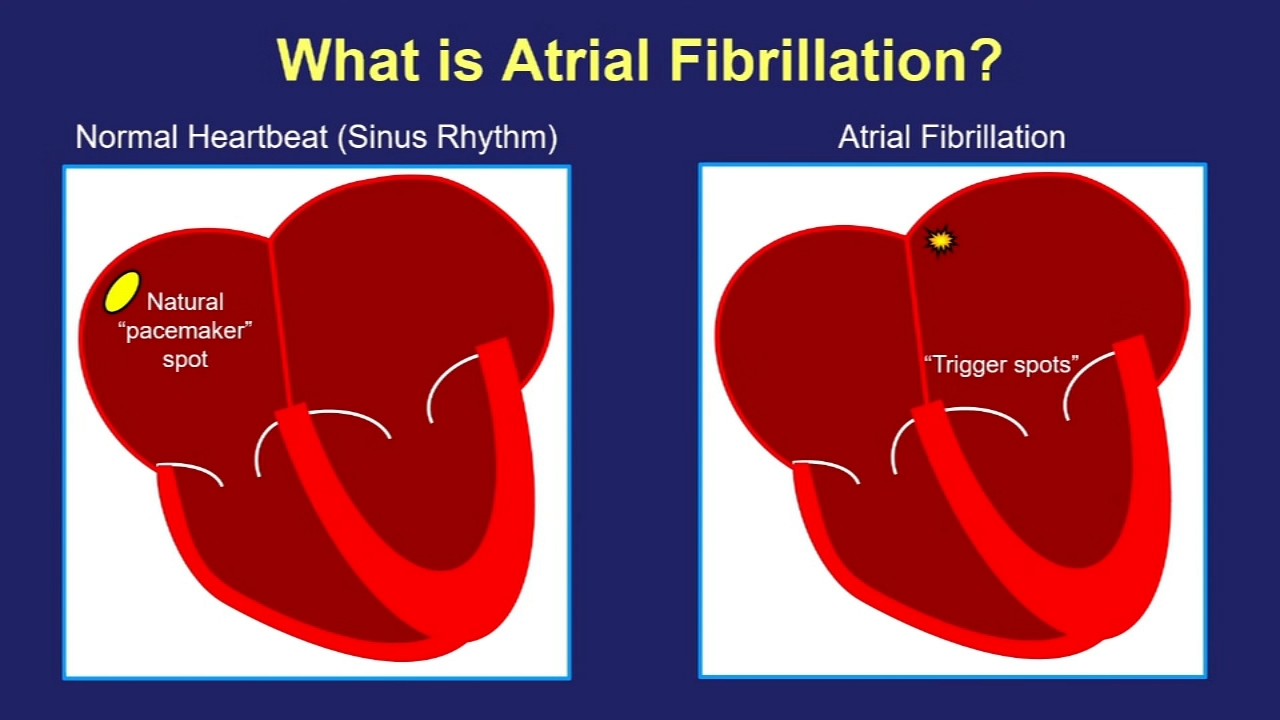 Turning off atrial fibrillation with cardiac ablation
