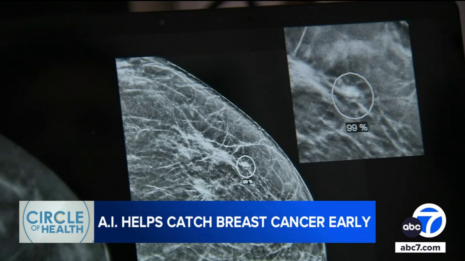 Radiologists at Providence St. Joseph Hospital in Orange County use AI to detect breast cancer earlier Radiologists at Providence St. Joseph Hospital in Orange County use AI to detect breast cancer earlier