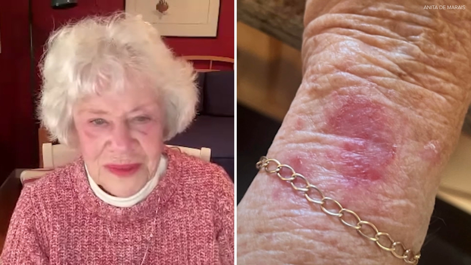 Bay Area 90-year-old's Apple Watch causes mysterious 'big red spot' on wrist