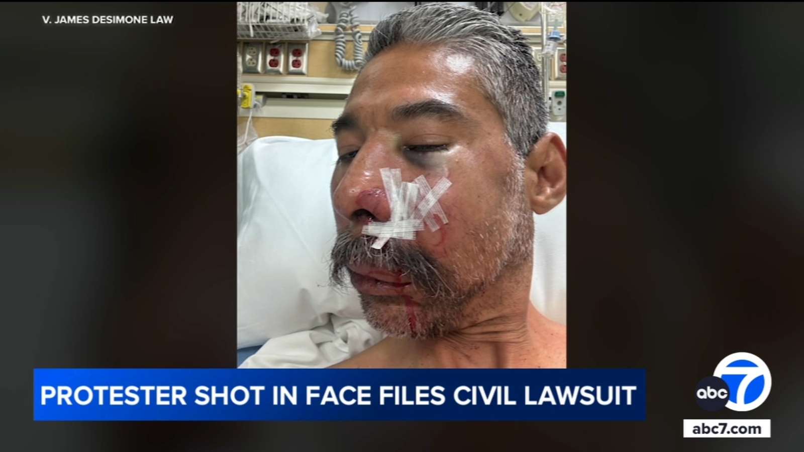 Protester shot in face with foam projectile during anti-ICE protest suing LAPD
      