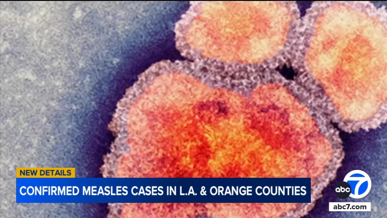 Second measles case in LA County this year confirmed