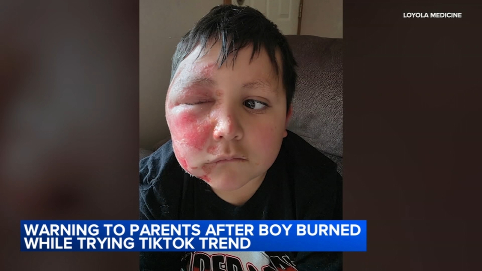 9-year-old severely burned after following TikTok trend, hospital says