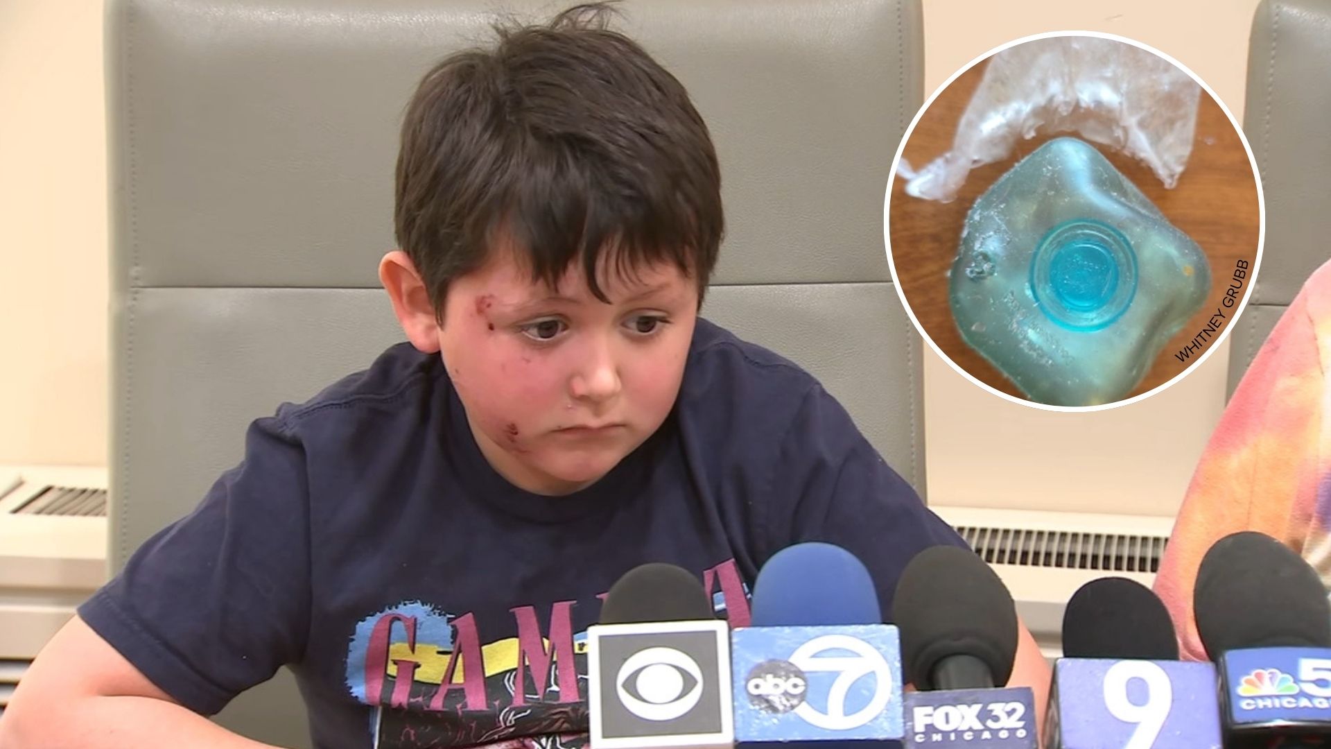Burn victim urges kids to not follow 'Needoh Cube microwave trend' 