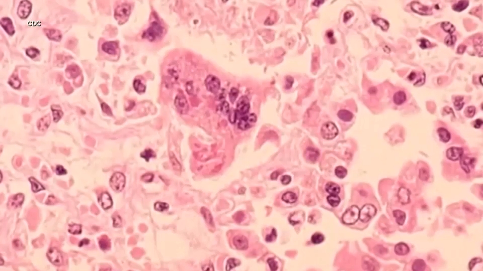 First NYC measles case reported of 2026