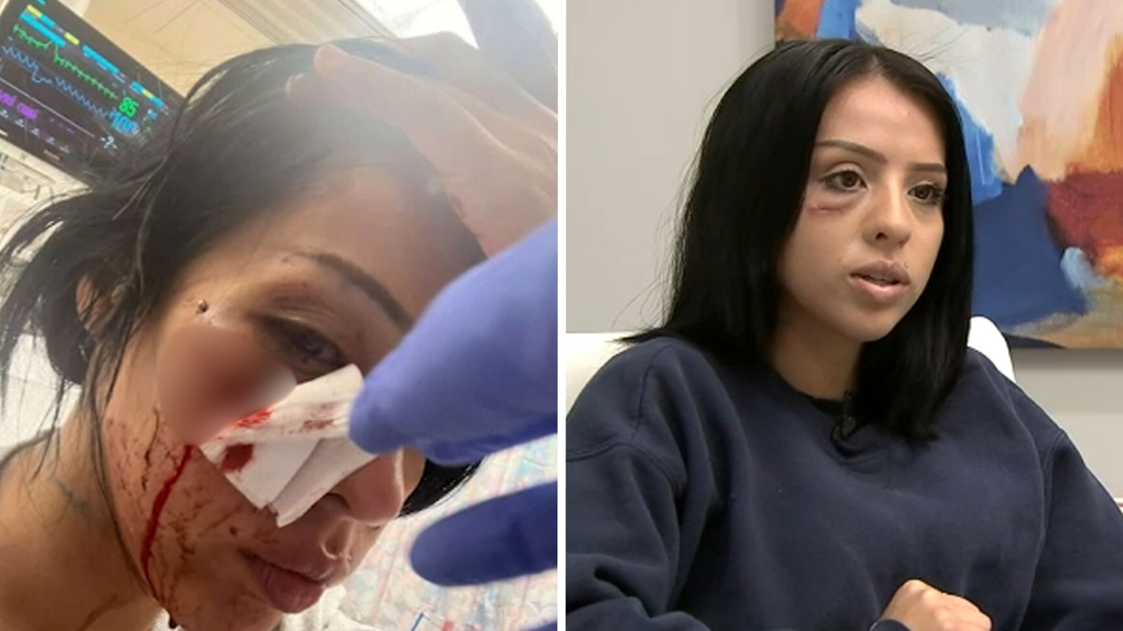 Woman shot in face with less-lethal round during ICE protest files claim against Los Angeles police