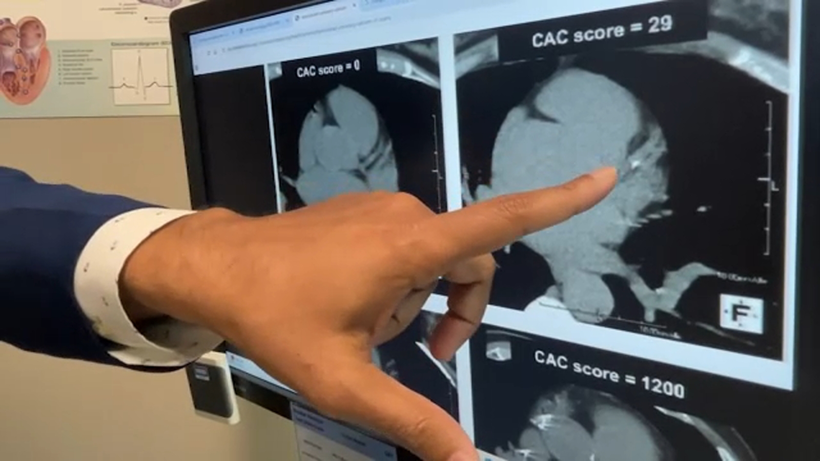 Computerized scan of heart can help prevent potential problems