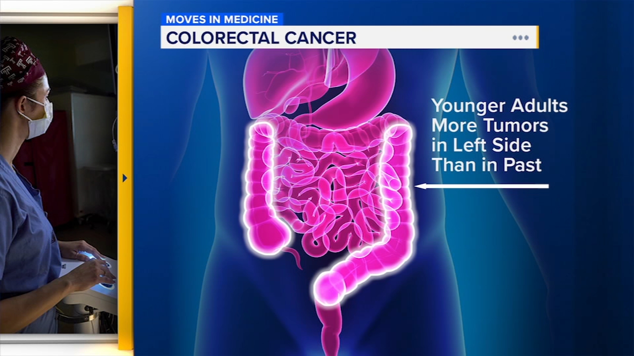 Understanding the rise in colorectal cancer in under-50s | Moves
