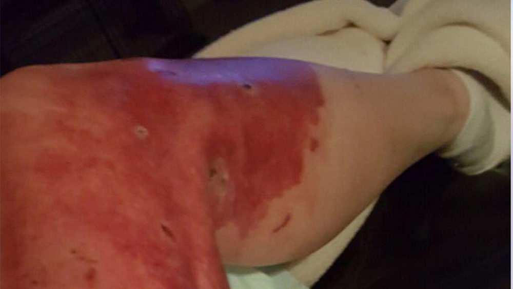 Navy veteran claims e-cigarette exploded in his pocket