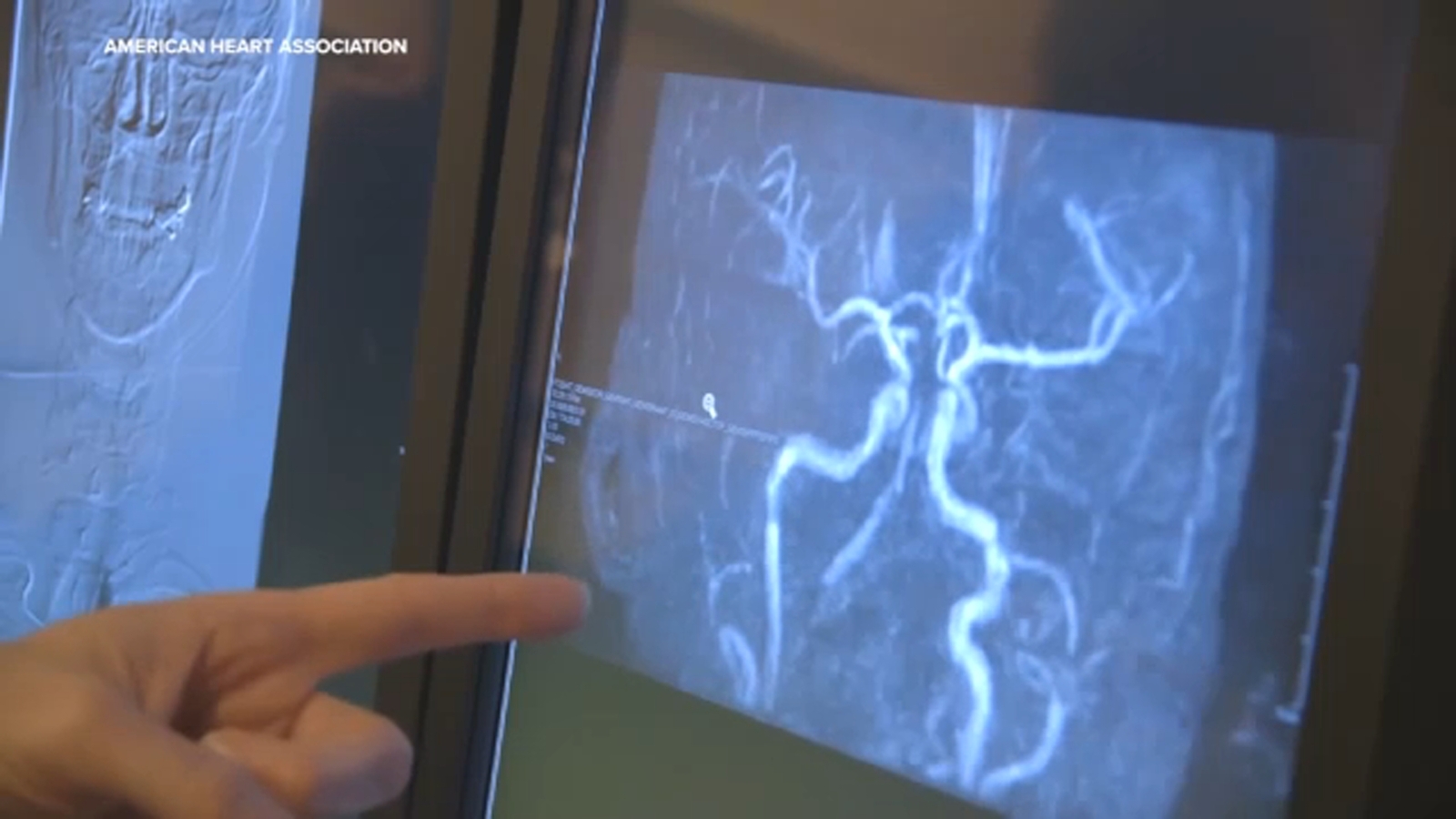 Stroke Awareness Month: Recognizing warning signs to act quickly ...