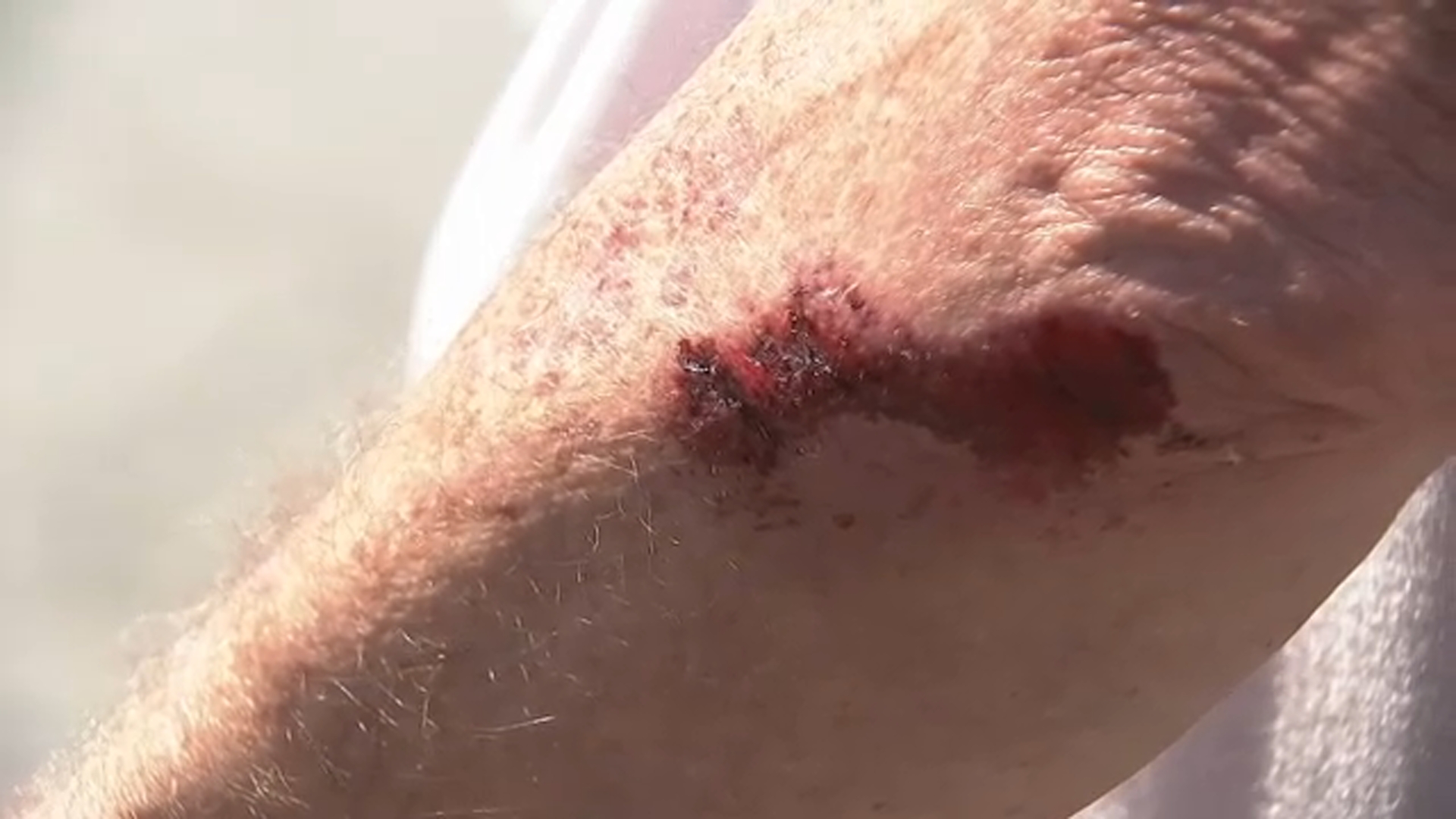 Images show scrapes on Ronald Knesil's elbow after a lengthy struggle with a carjacking suspect.
