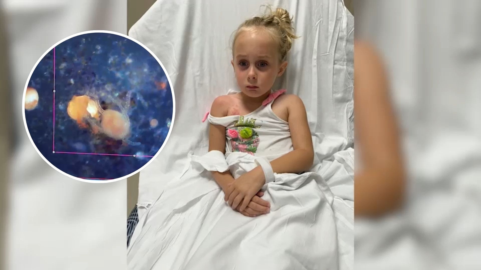 6-year-old stung by clinging jellyfish in New Jersey river