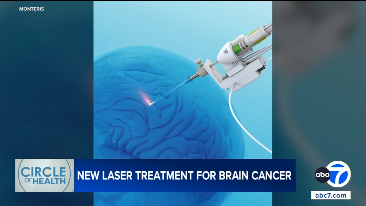 Laser treatment helps brain cancer patient surpass 7-year survival milestone