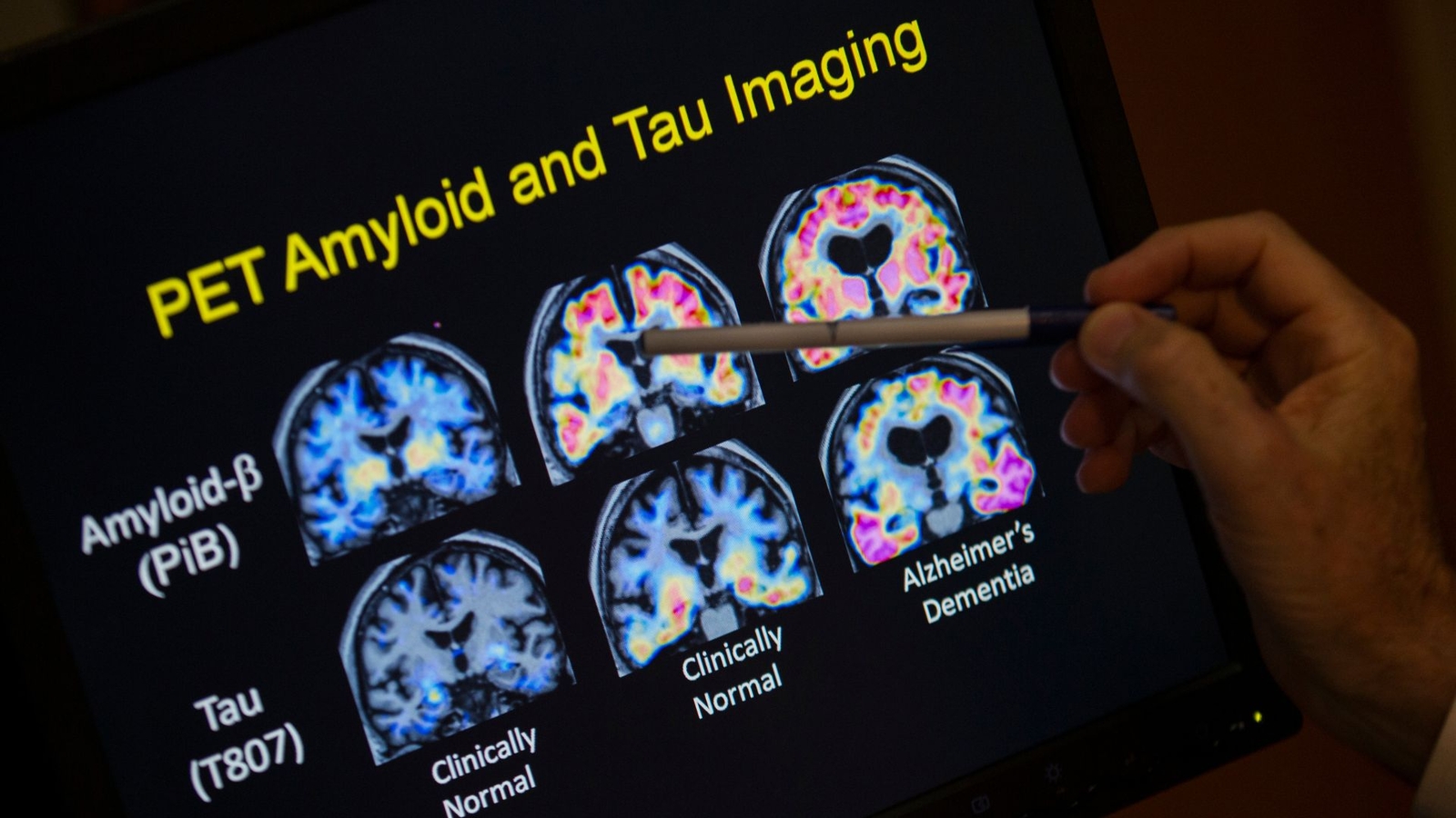 What is Alzheimer's disease? Signs and symptoms to know