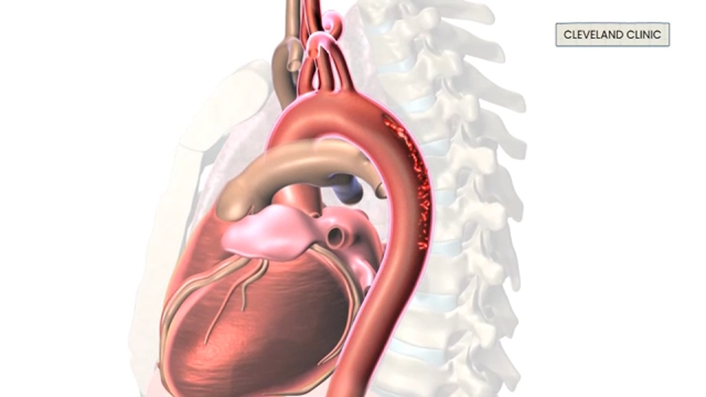 What is aortic dissection?