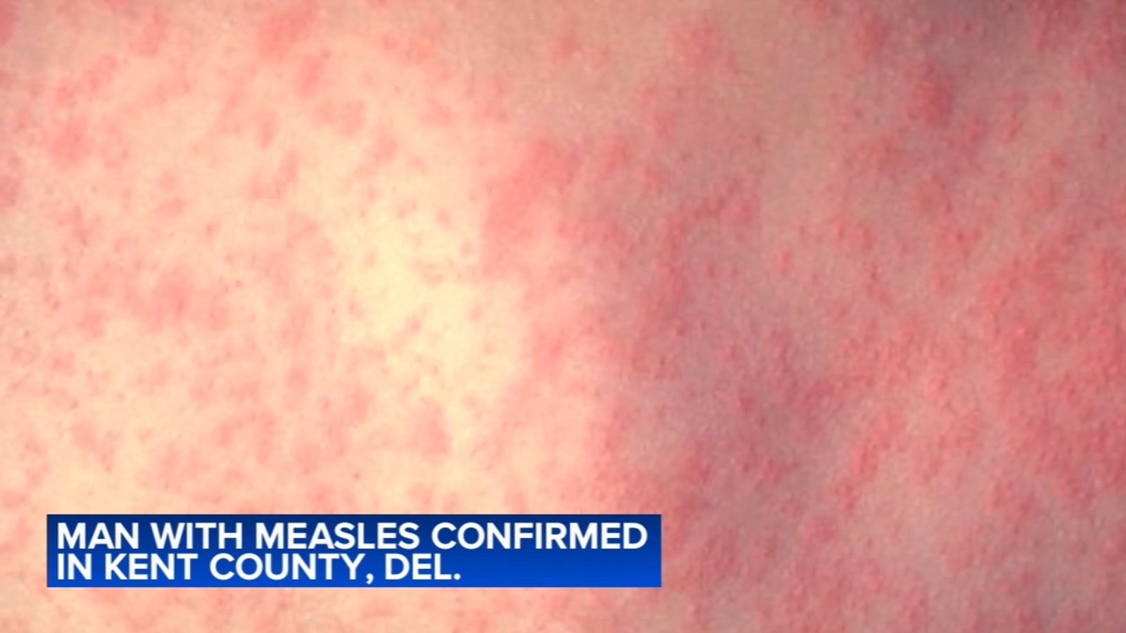 Unvaccinated Kent County man becomes 1st Delaware measles case in more than a decade