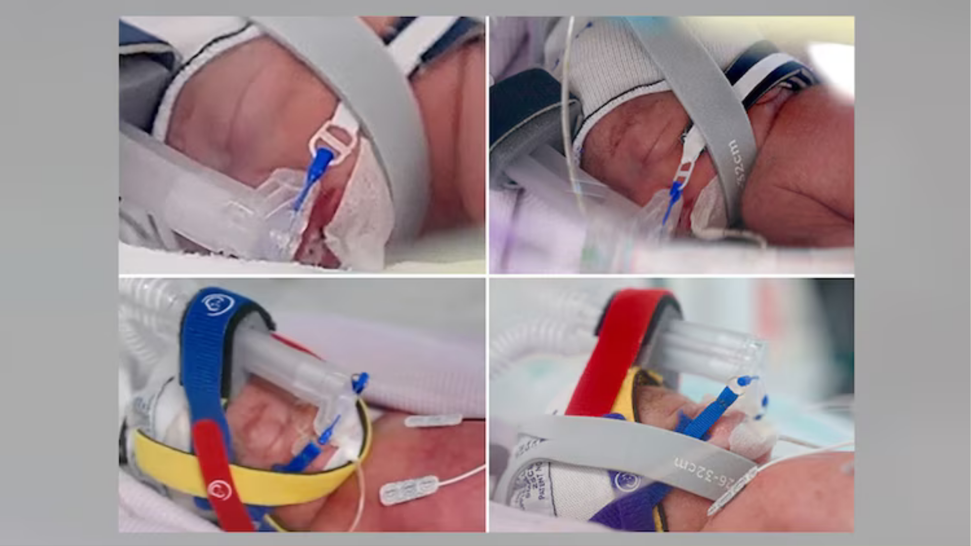 A woman gave birth to a identical quadruplet girls at Royal Brisbane and Women's Hospital in Queensland, Australia.