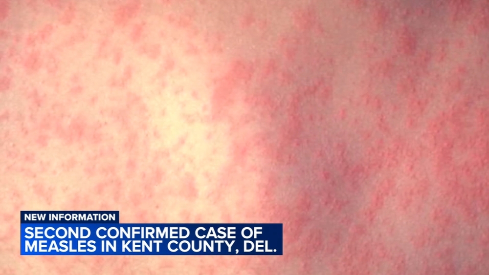 Delaware confirms 2nd measles case from another unvaccinated man in Kent County