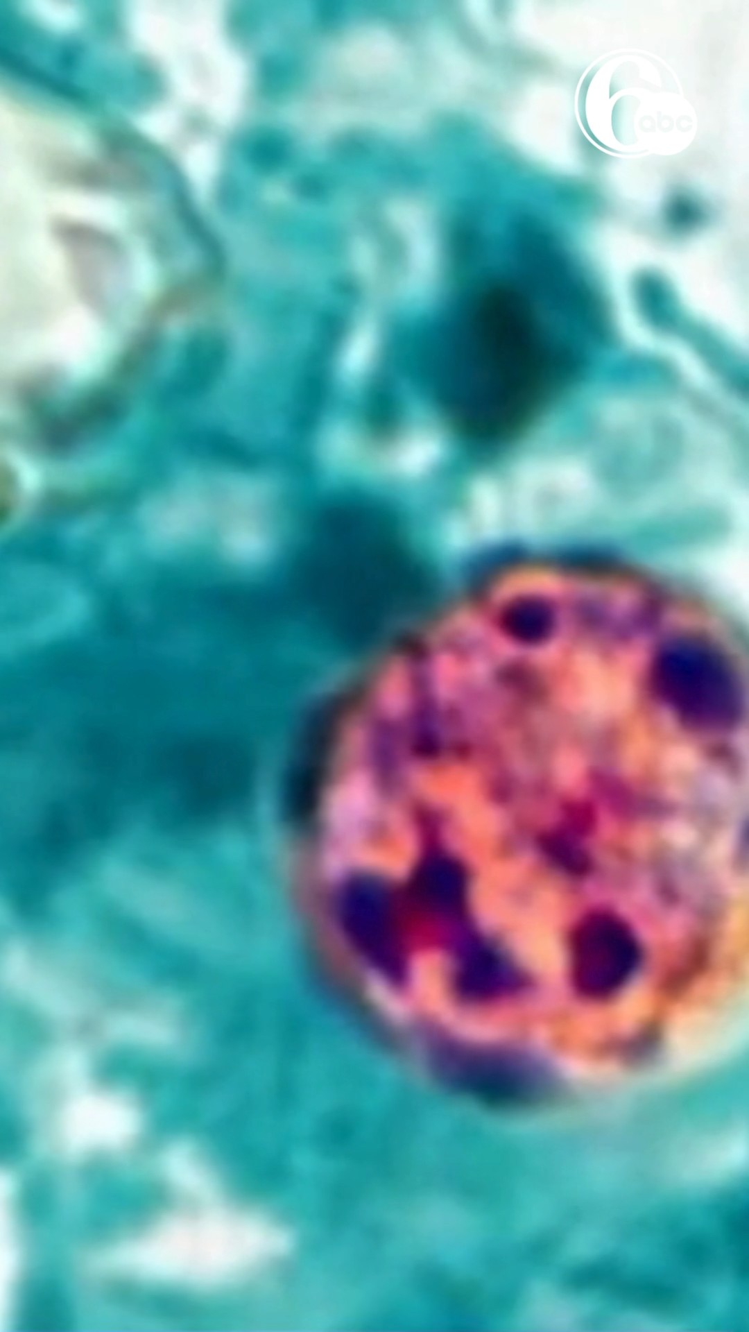 RFK Jr. says cyclosporiasis outbreak is 'under control'