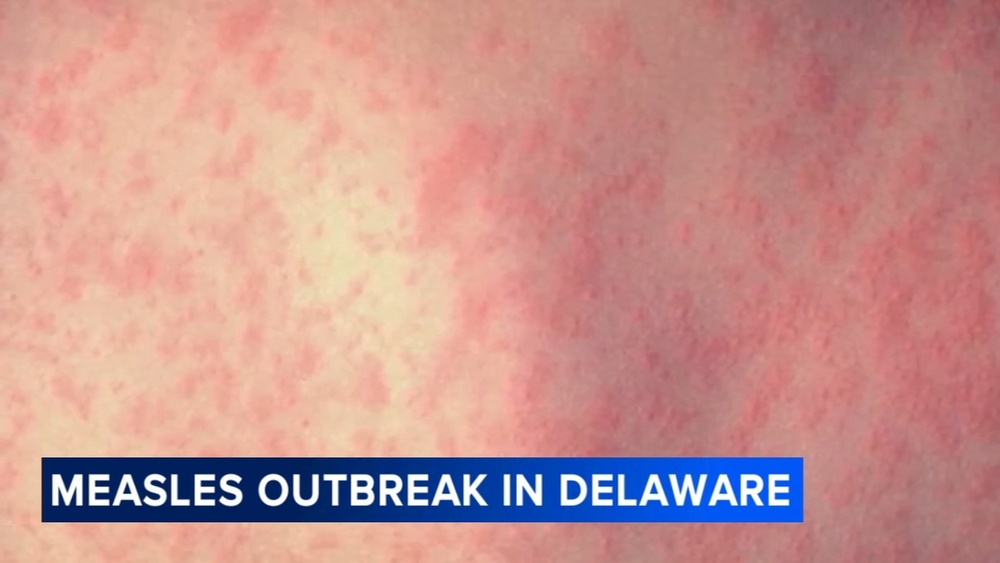 Measles outbreak declared in Delaware; cases also rising in Chesco