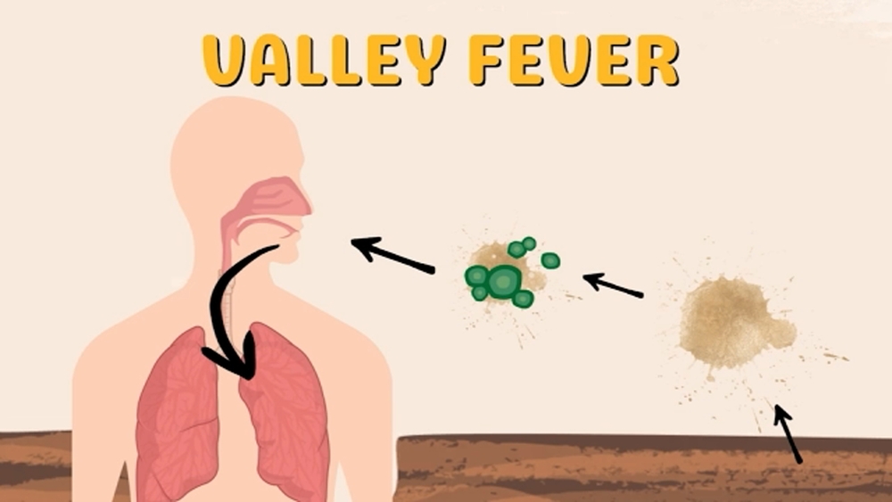 Inspire Health launches Valley Fever Care Program to expand treatment