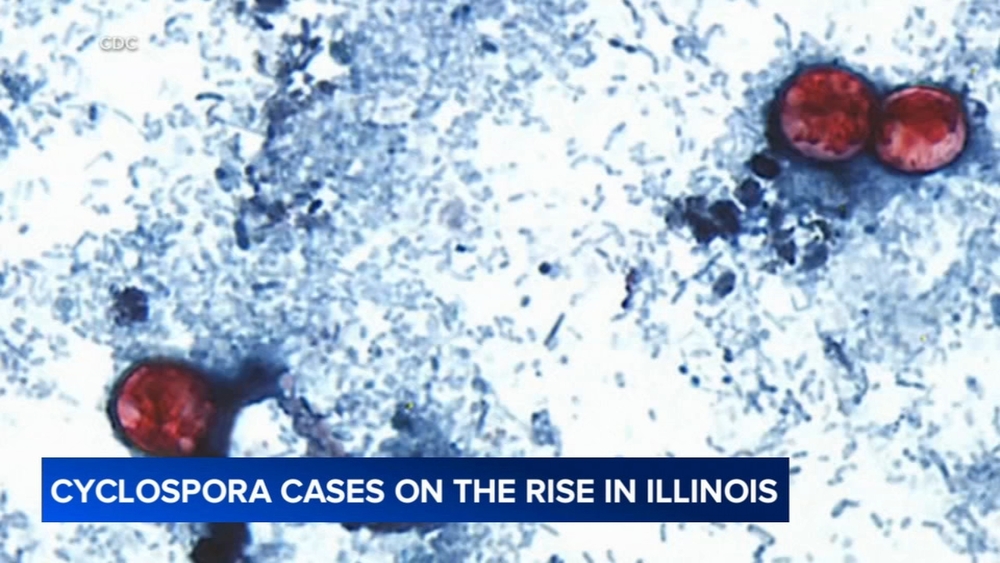 Doctor gives update on intestinal parasite as outbreak spread to Illinois