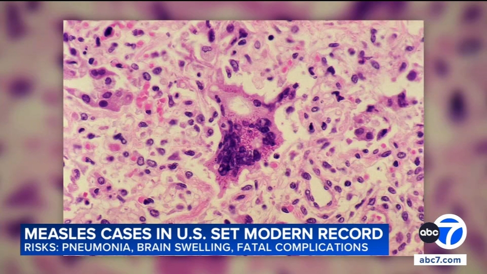 US measles cases reach 35-year high