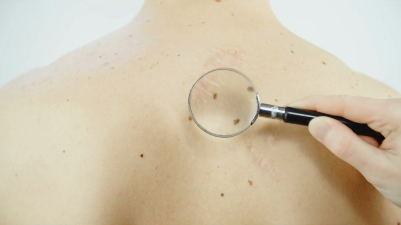 When melanoma isn't just a bad-looking mole