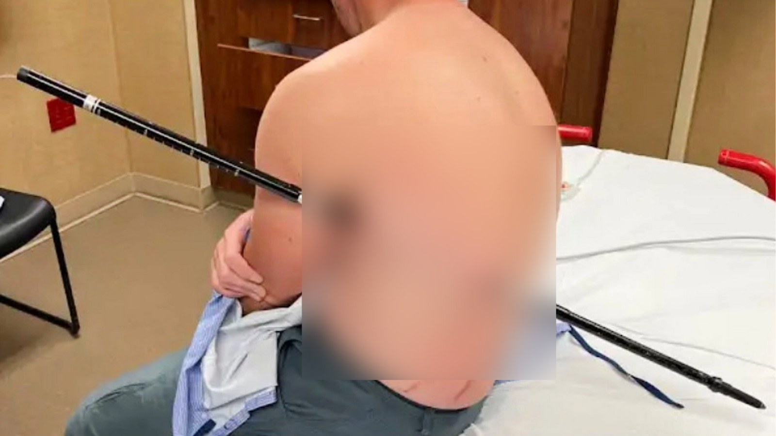 Montana man hikes out of the mountains to get help after he was impaled by a trekking pole Montana man hikes out of the mountains to get help after he was impaled by a trekking pole