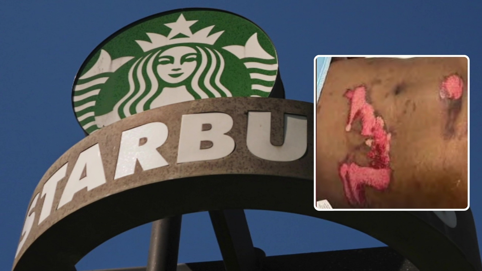 SoCal woman sues Starbucks after spilled coffee causes severe burns SoCal woman sues Starbucks after spilled coffee causes severe burns