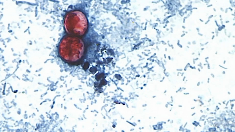 NC sees ongoing surge in Cyclospora cases and hospitalizations