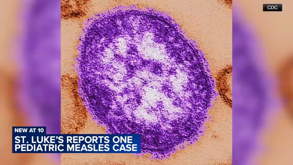 Measles case reported at St. Luke's hospital in Lehigh Valley