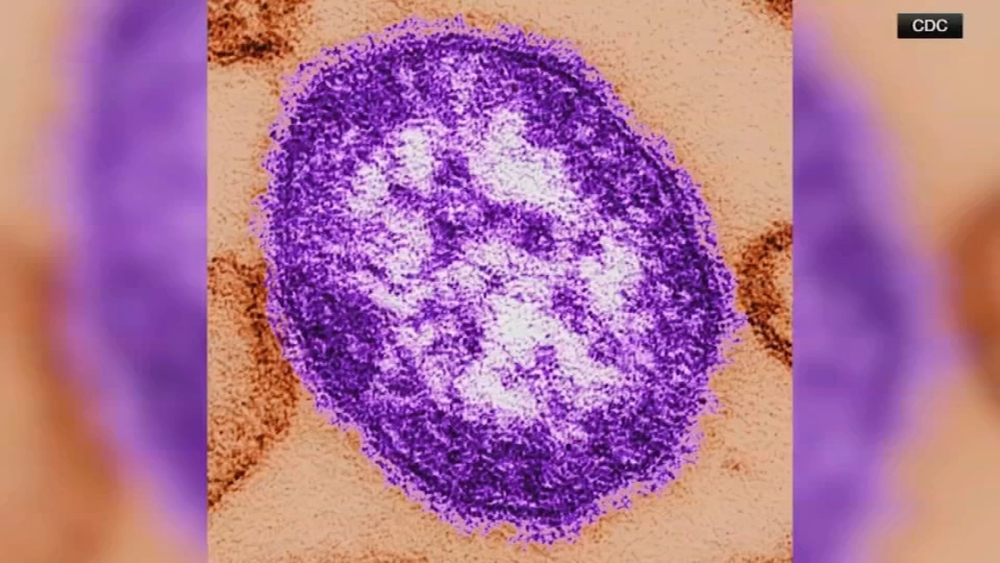 Child among 2 being treated for measles in Lehigh County, health officials say